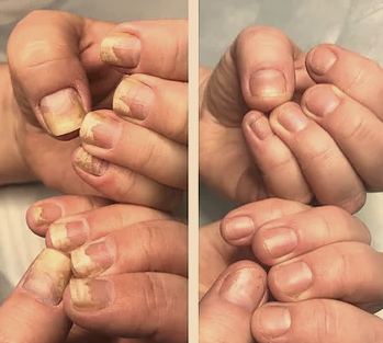 Отслоение ногтя: почему возникает и как лечить онихолизис