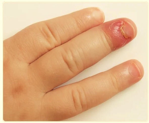 Грибок ногтей у взрослых: симптомы, причины, лечение